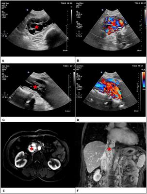 Diagnostic experience of intravenous leiomyomatosis with emphasis on conventional ultrasonography imaging: a single-center study